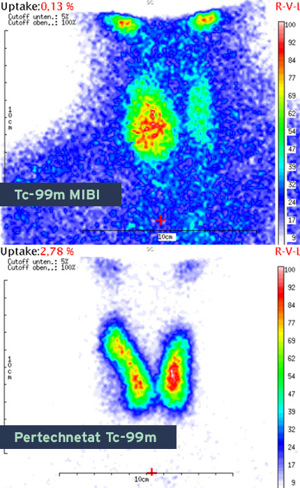 Tc-99m MIBI im Vergleich zu Pertechnetat Tc-99m