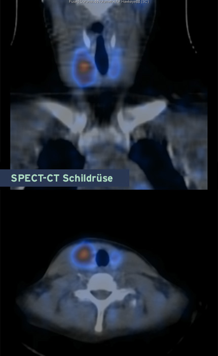 SPECT-CT Schildrüse